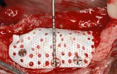Fig 130 Labial view of a perforated membrane Fig 131 Labial view of a - фото 35