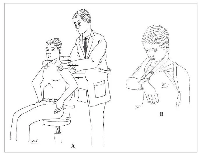 Fig 19 Tractament conservador de les fractures de la clavícula A reducció - фото 10