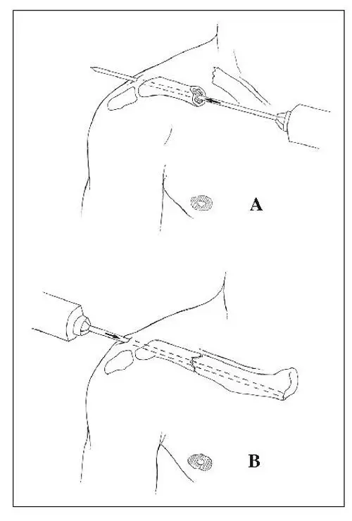 Fig 110 Tractament quirúrgic de les fractures de la clavícula Enclavatge - фото 11