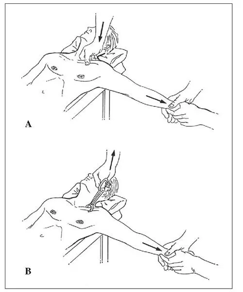 Fig 15 Maniobres de reducció de la luxació esternoclavicular A anterior B - фото 6