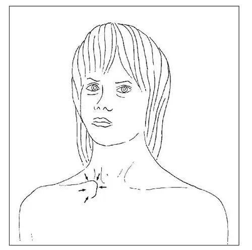 Fig 14 Tumoració produïda per una luxació esternoclavicular anterior La - фото 5