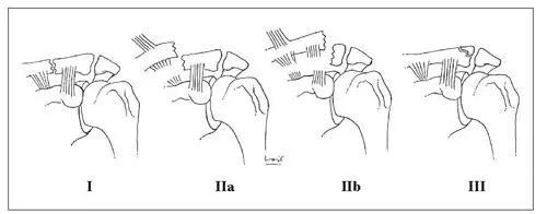 Fig 111 Diversos tipus de fractures de lextrem distal de la clavícula El - фото 12