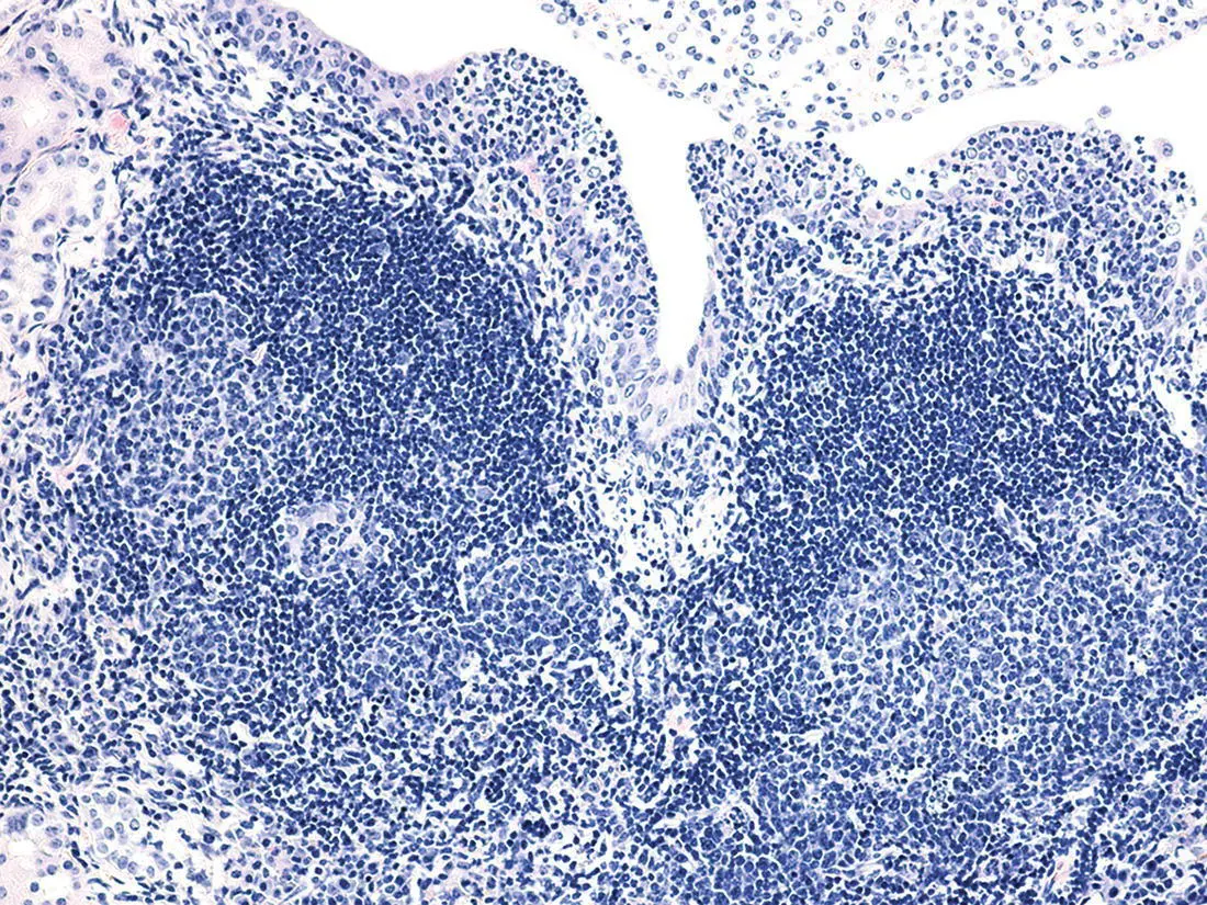 Figure 78 Tertiary lymphoid structures Tertiary lymphoid tissue with two - фото 52