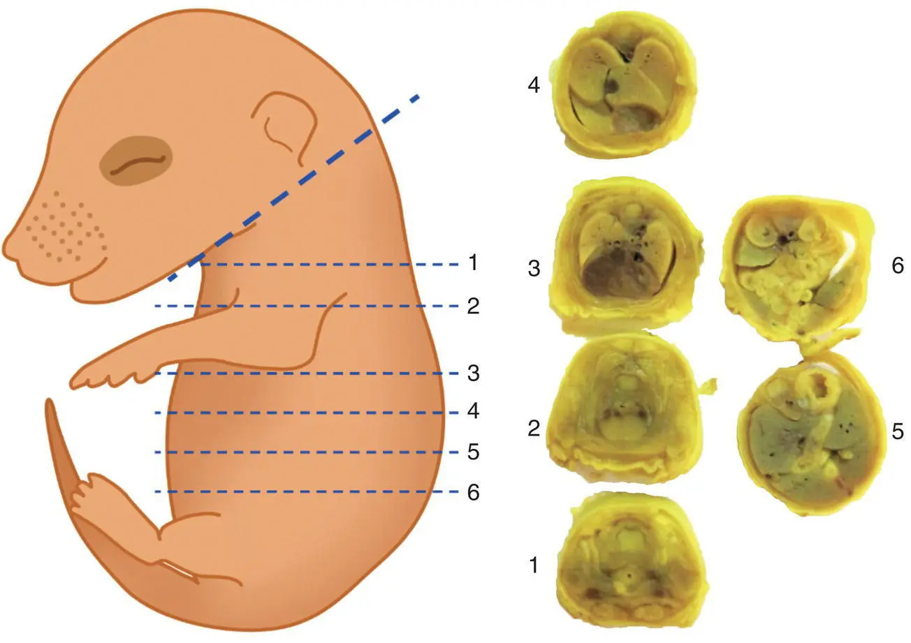 Figure 510 Sectioning Wilsons technique to allow macroscopic evaluation of - фото 29