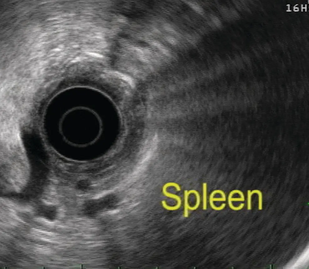 Figure 74 Image of spleen by radial ultrasound Figure 75 Image of spleen - фото 62
