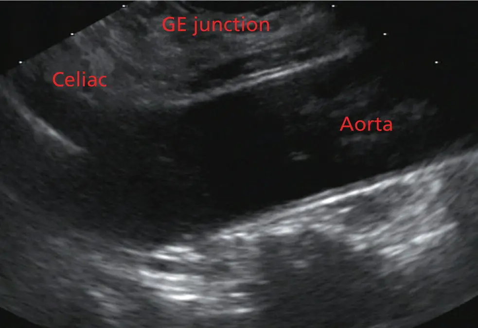 Figure 211 Linear array image at the level of the celiac artery Withdrawing - фото 26