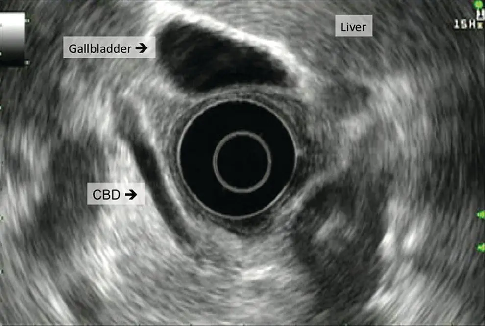 Figure 53 Gallbladder from the duodenal bulb radial echoendoscope CBD - фото 41