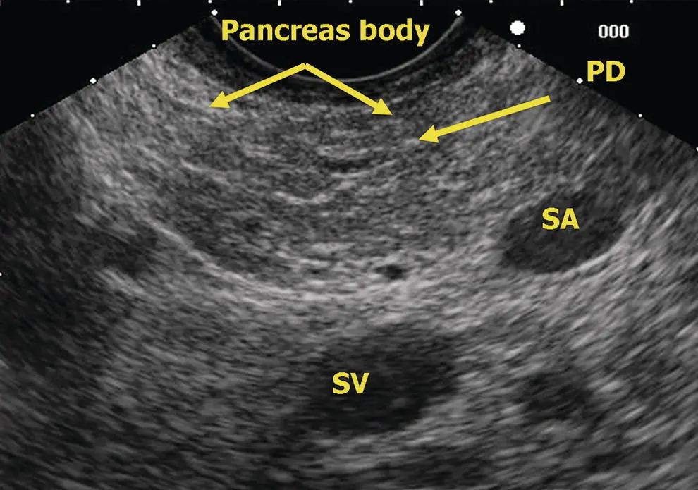 Figure 611 Linear EUS pancreas body PD pancreatic duct SA splenic artery - фото 55