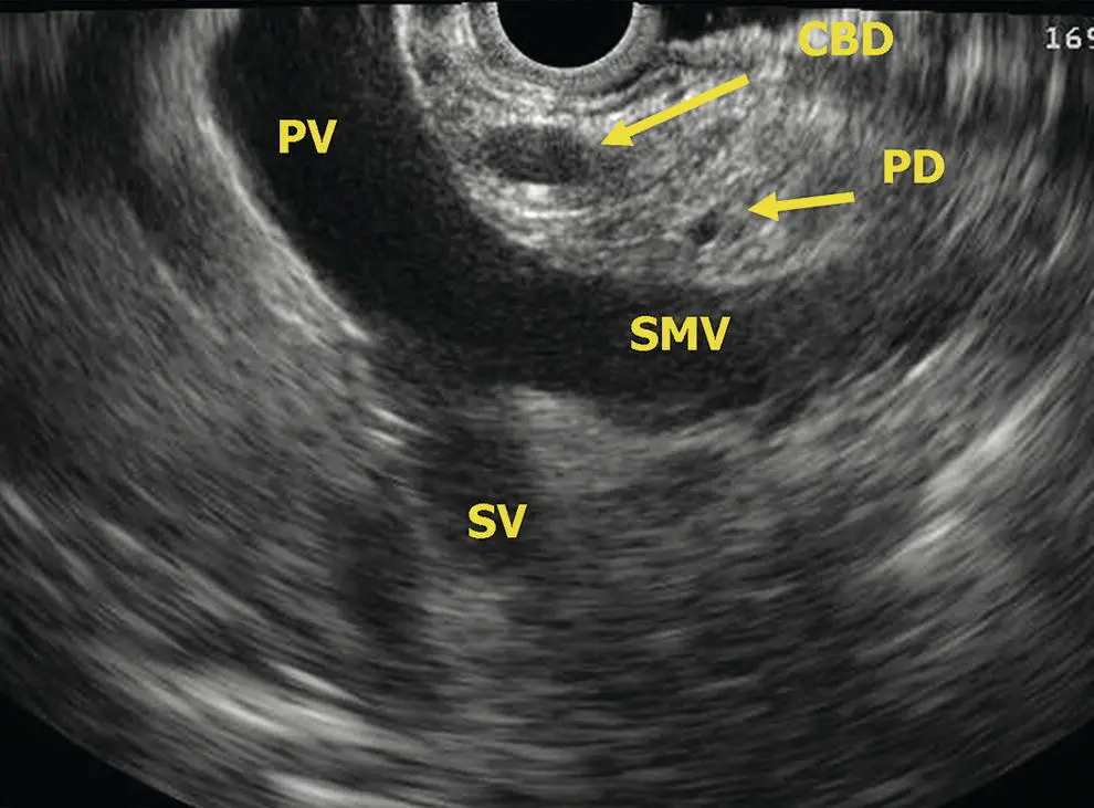 Figure 69 Radial EUS head of pancreas vasculature CBD common bile duct - фото 53