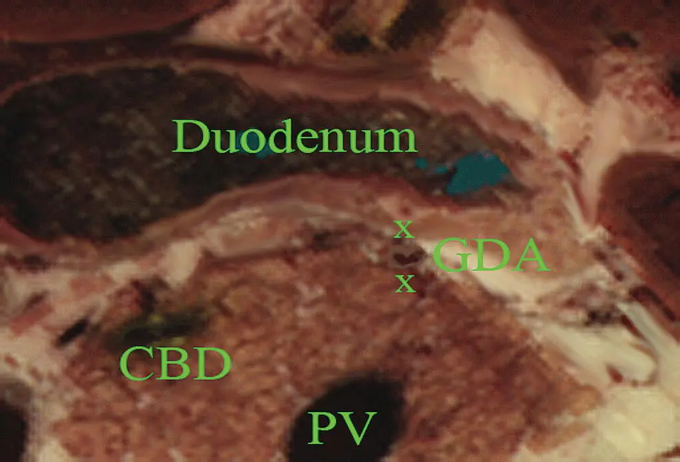 Figure 18 Crosssectional anatomy generated within the plane shown in Figure - фото 10
