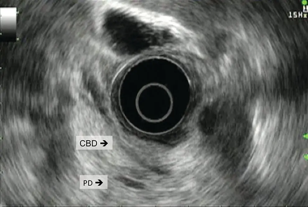 Figure 52 Bile duct followed towards the head of the pancreas from the - фото 40