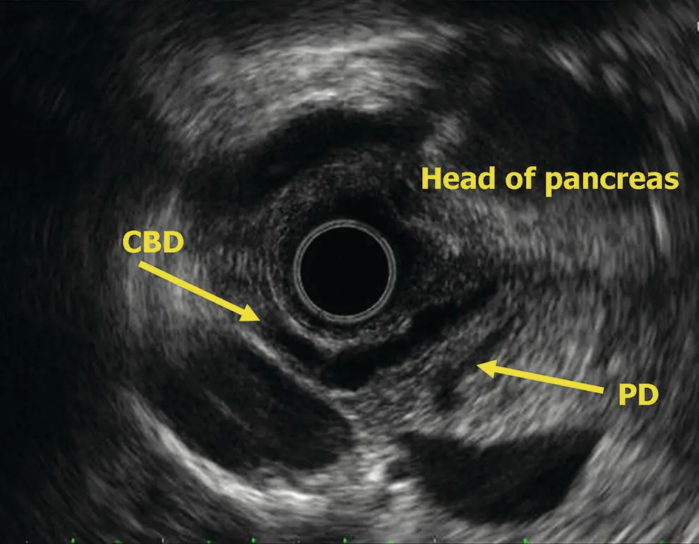 Figure 68 Radial EUS head of pancreas CBD common bile duct PD pancreatic - фото 52