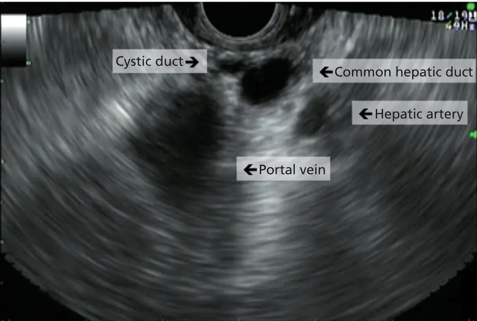 Figure 55 Common hepatic duct and cystic duct as visualized from the duodenal - фото 43