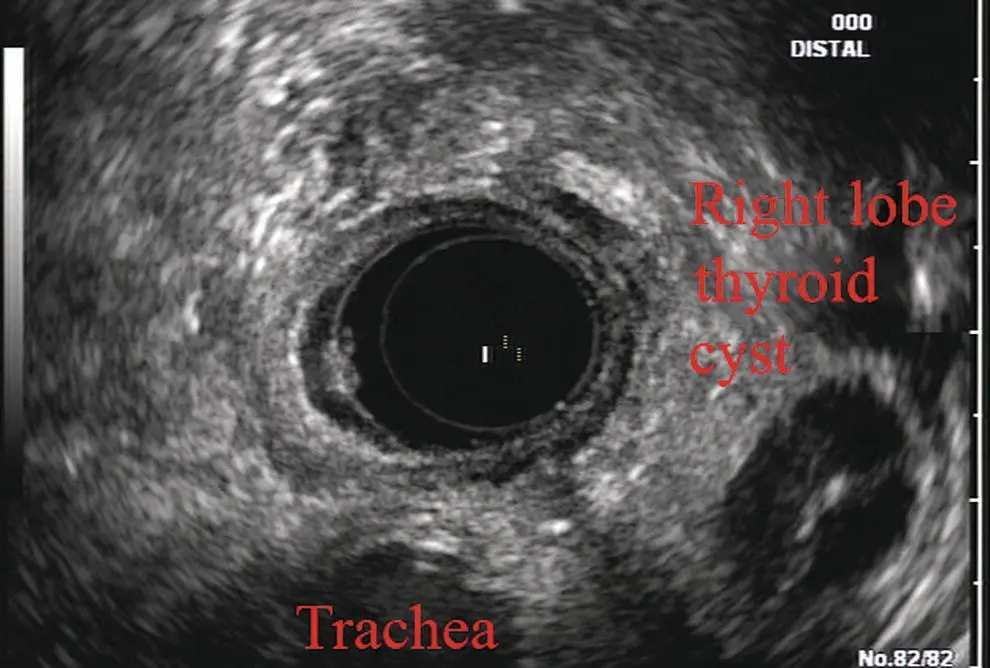 Figure 29 Radial array image at the level of the thyroid The origin of the - фото 24