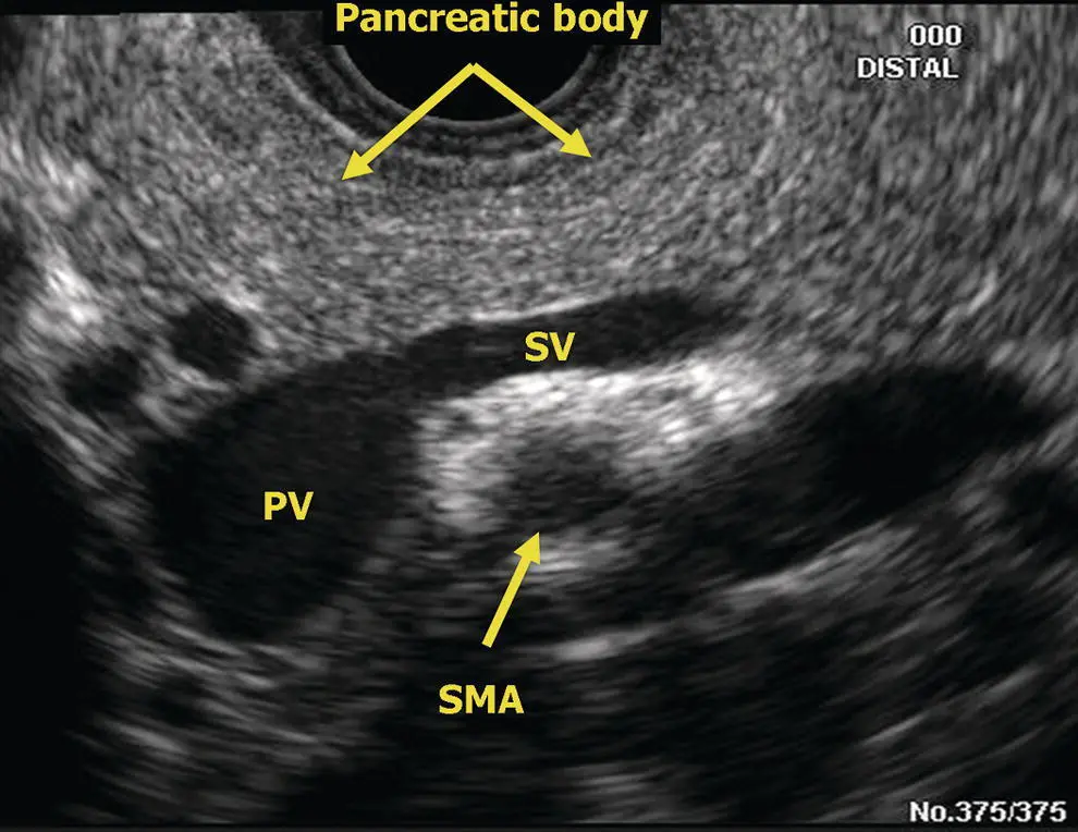 Figure 61 Radial EUS pancreatic body and portalsplenic vein confluence PV - фото 45