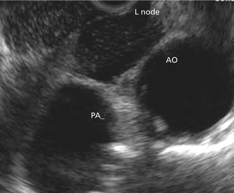 Figure 35 Aortopulmonary window station stations 4L 5 and 6 AO aorta L - фото 33