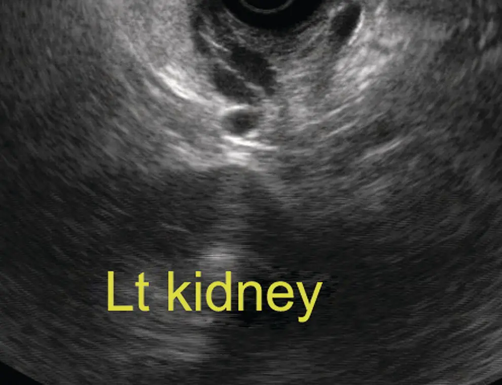 Figure 76 Image of left kidney by radial ultrasound Figure 77 Image of - фото 64