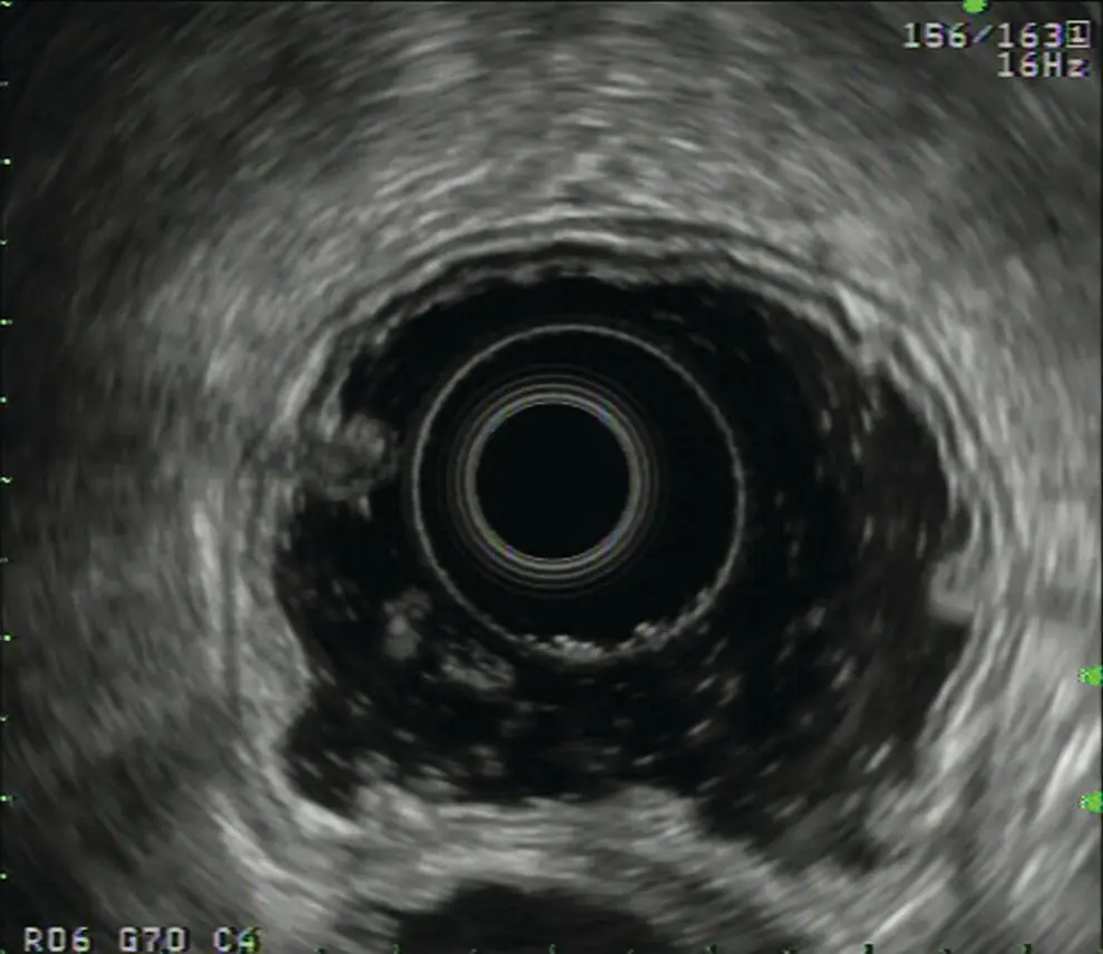 Figure 41 Circumferential image of the gastric wall after filling and - фото 35
