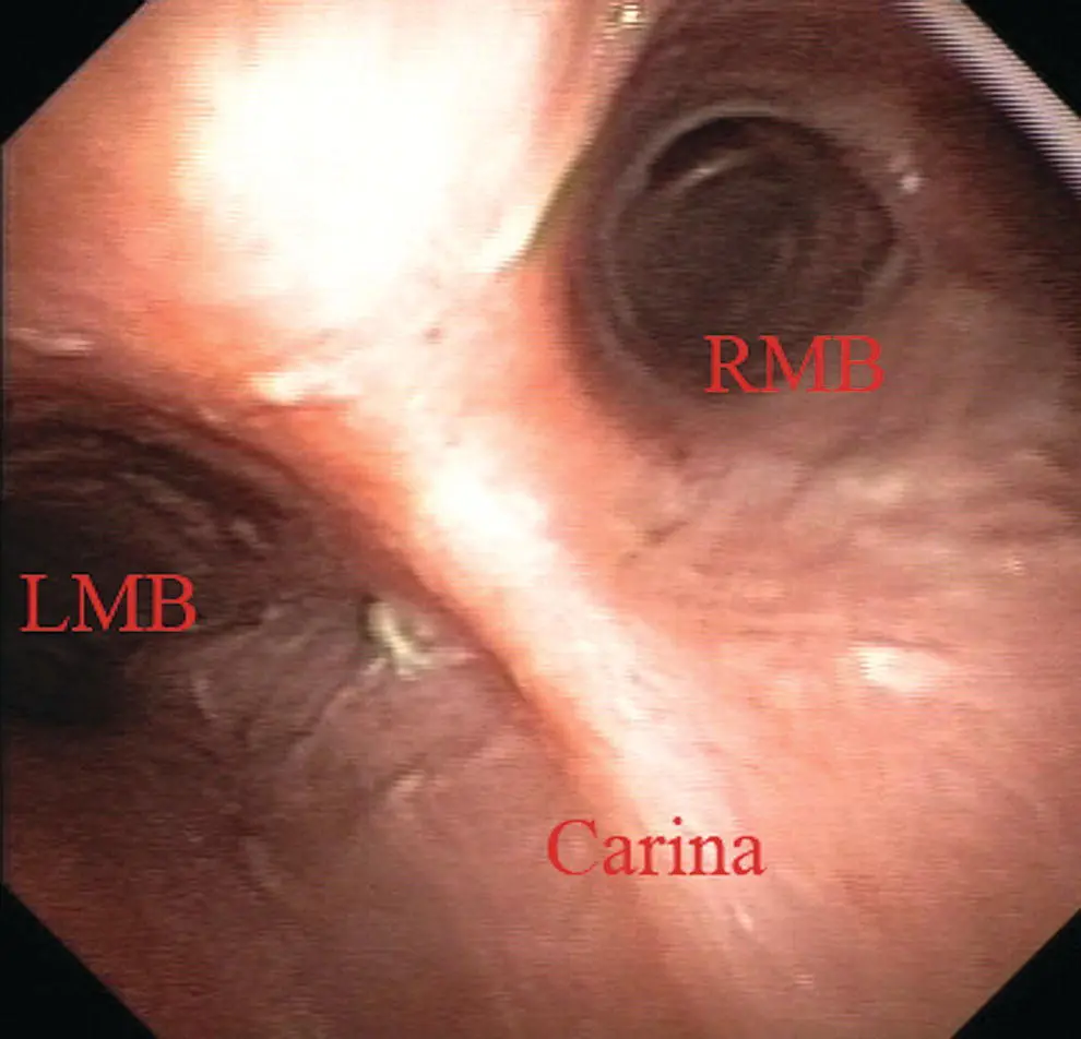 Figure 19 Endobronchial view of the carina showing the right RMB and left - фото 11