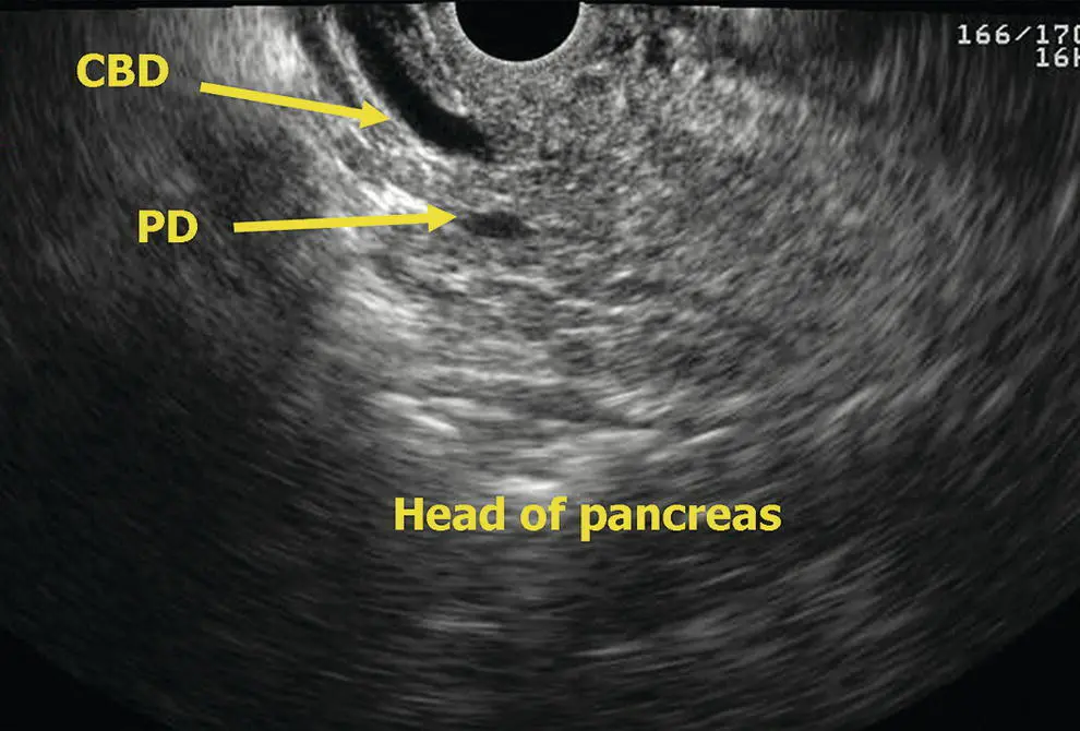Figure 614 Linear EUS head of pancreas CBD common bile duct PD pancreatic - фото 58