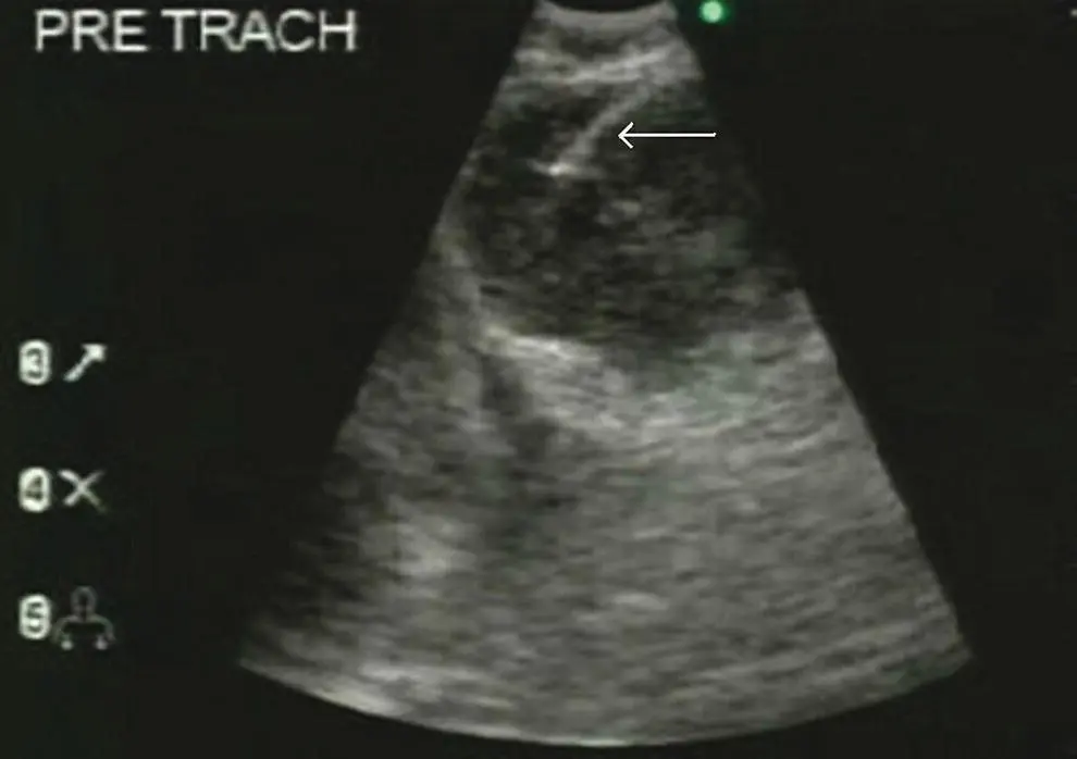 Figure 36 Endobronchial ultrasound EBUS images of common mediastinal - фото 34