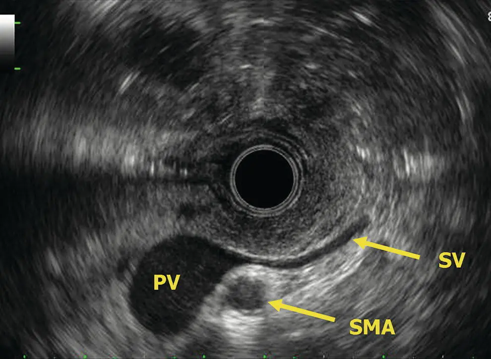 Figure 62 Radial EUS portalsplenic vein confluence PV portal vein SMA - фото 46