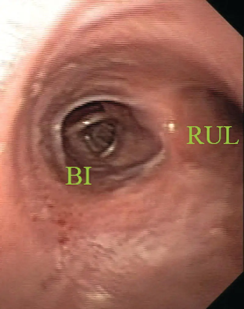 Figure 110 Endobronchial view of the first branch of the right mainstem - фото 12