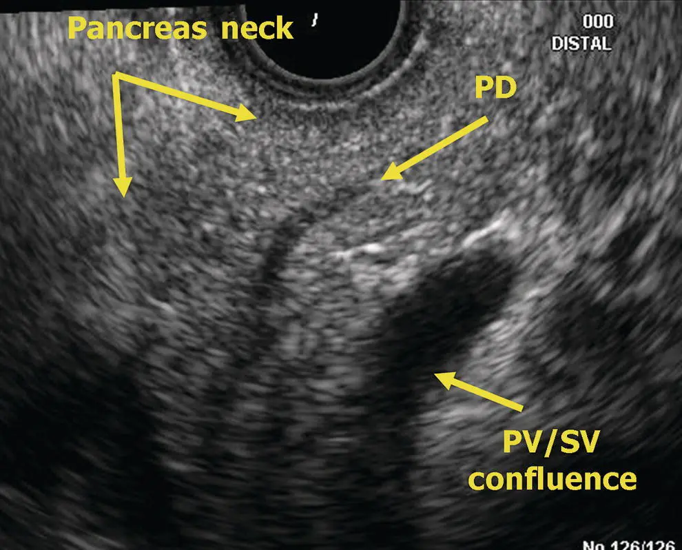 Figure 65 Radial EUS pancreas neck PD pancreatic duct PV portal vein SV - фото 49