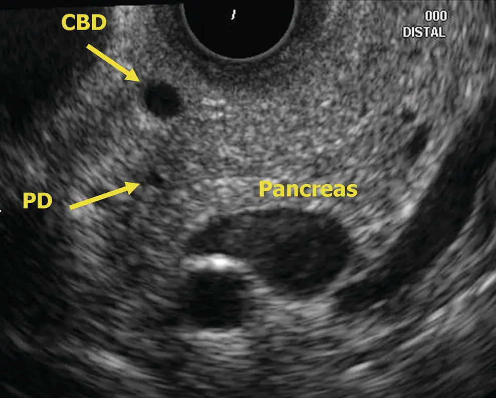 Figure 610 Radial EUS head of pancreas CBD common bile duct PD pancreatic - фото 54