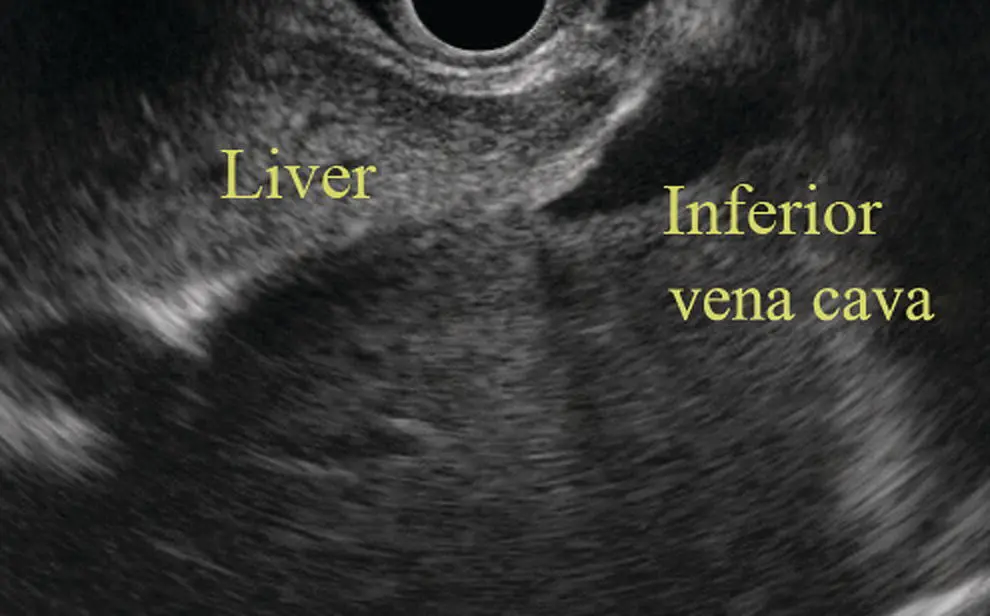 Figure 73 Image of liver by linear ultrasound Radial endosonography With - фото 61
