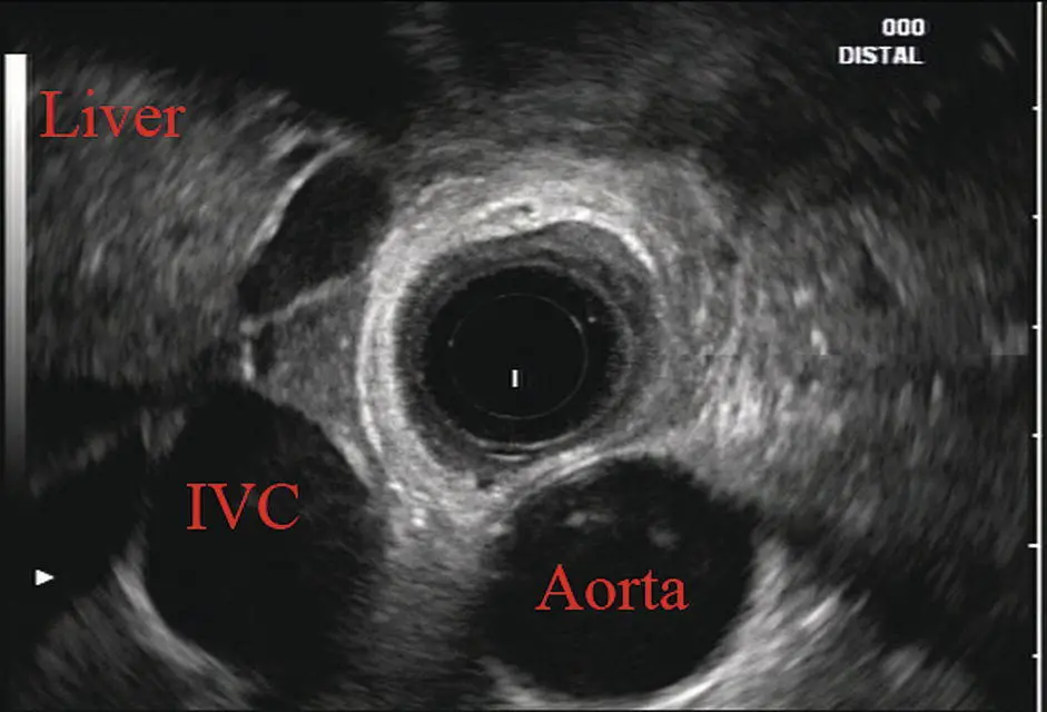 Figure 22 Radial array image at gastroesophageal GE junction IVC inferior - фото 17