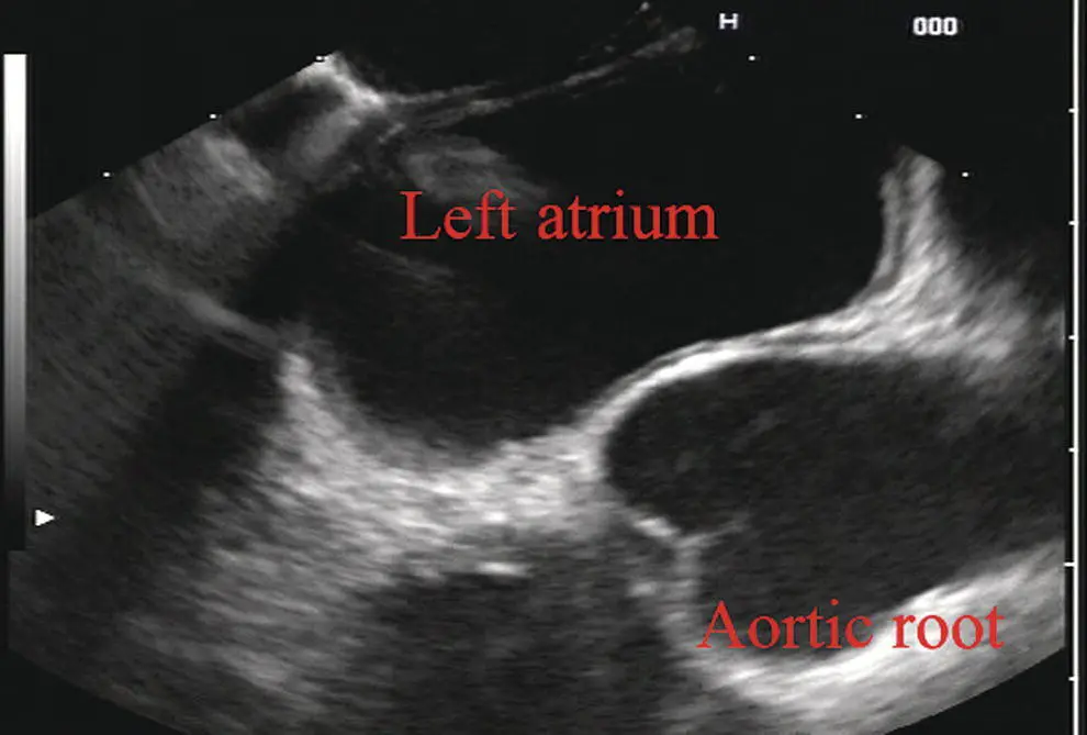 Figure 212 Linear array image at the aortic root Figure 213 Linear array - фото 27