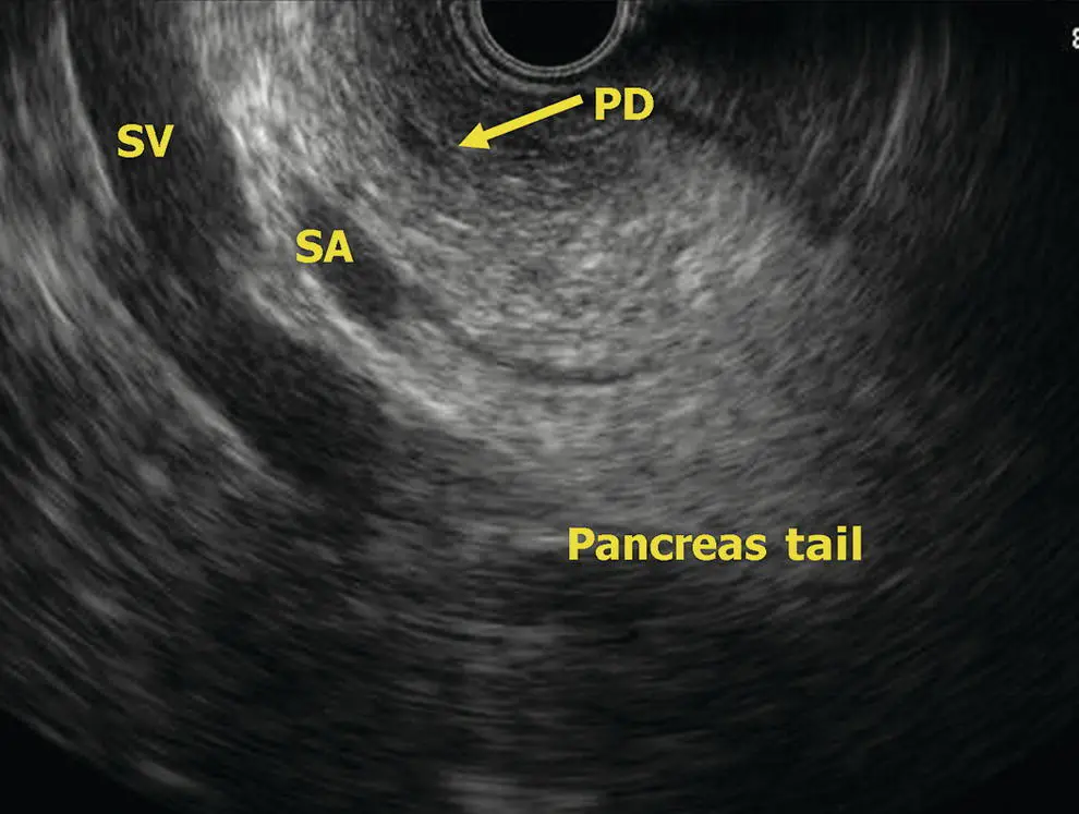 Figure 63 Radial EUS pancreas tail PD pancreatic duct SA splenic artery - фото 47