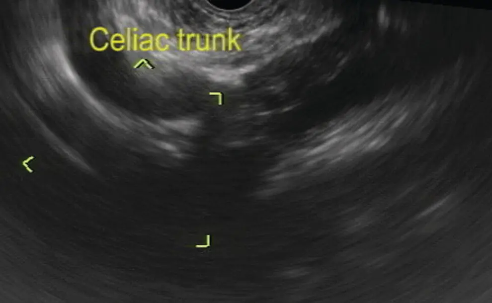 Figure 72 Celiac artery imaging by linear ultrasound Figure 73 Image of - фото 60