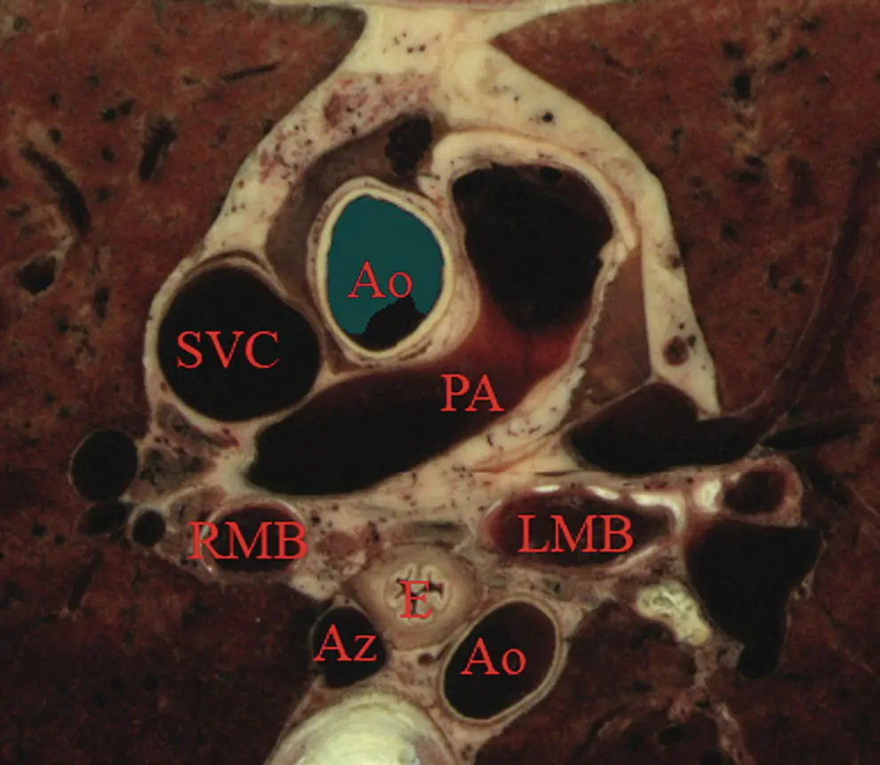 Figure 13 Transaxial crosssection of digital anatomy taken at the level of - фото 5