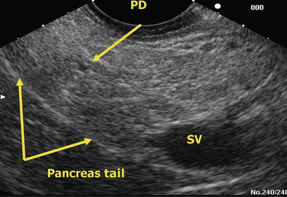 Figure 612 Linear EUS pancreas tail PD pancreatic duct SV splenic vein - фото 56