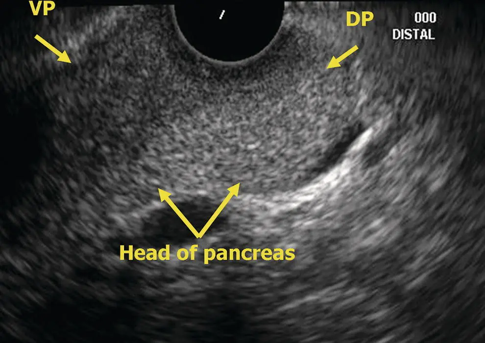 Figure 66 Radial EUS head of pancreas DP dorsal pancreas VP ventral - фото 50