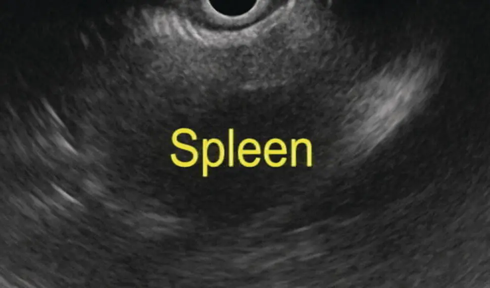 Figure 75 Image of spleen by linear ultrasound Linear endosonography With a - фото 63