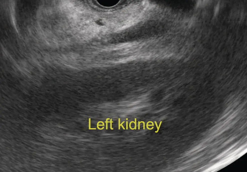 Figure 77 Image of left kidney by linear ultrasound Adrenal glands Radial - фото 65