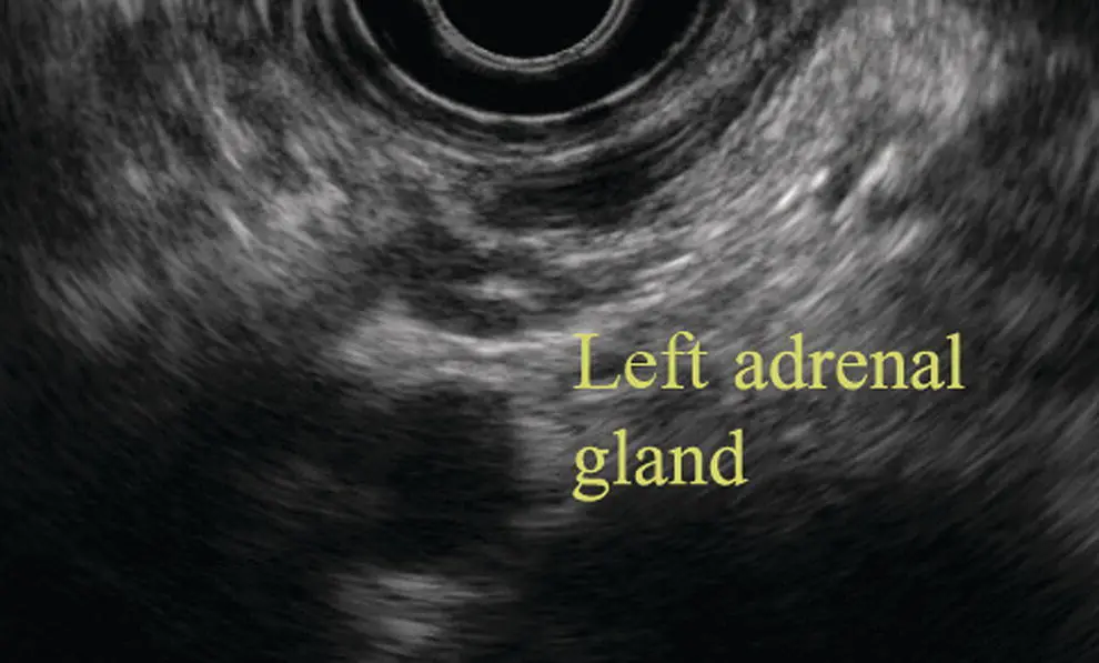 Figure 78 Image of left adrenal gland by radial ultrasound Figure 79 Image - фото 66