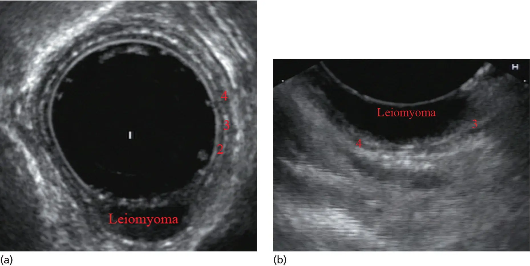 Figure 21 a Radial array image of esophageal wall with small echolayer II - фото 16