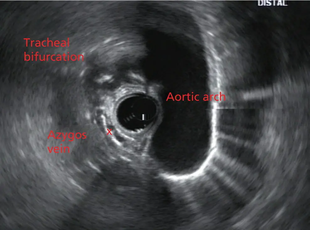 Figure 27 Radial array image at the mid aortic arch More proximally from the - фото 22