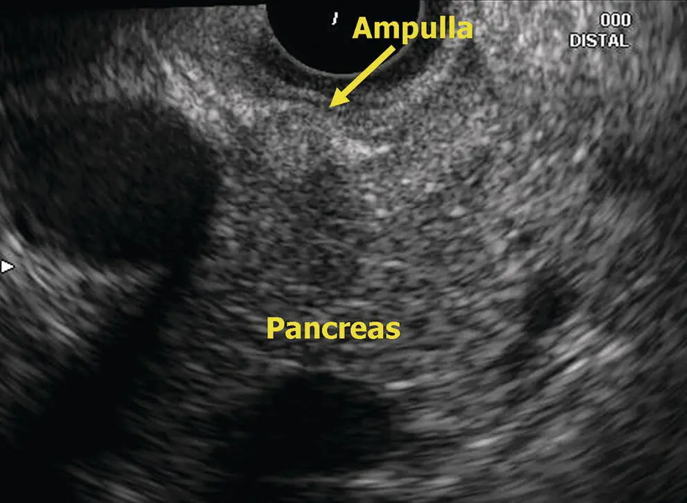 Figure 67 Radial EUS ampulla Figure 68 Radial EUS head of pancreas CBD - фото 51