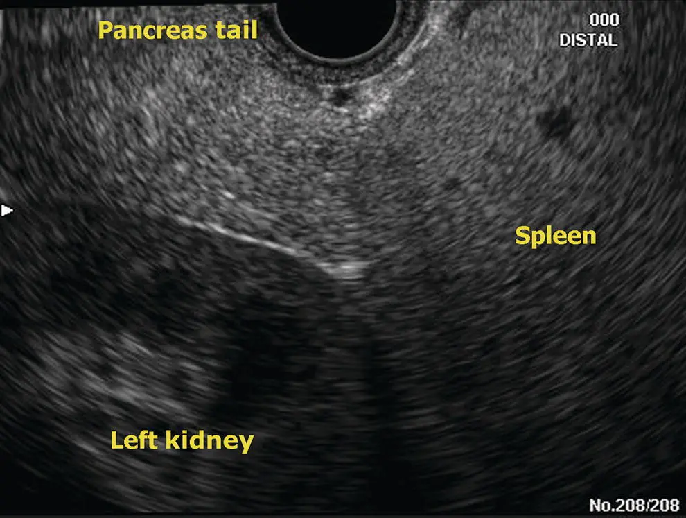 Figure 64 Radial EUS pancreas tail Figure 65 Radial EUS pancreas neck - фото 48