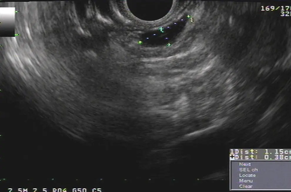 Figure 33 Lymph node at station 8 between calipers Figure 34 Subcarinal - фото 31