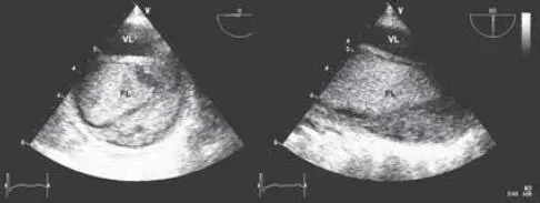 Fig 410 Disección de aorta descendente con trombosis de la falsa luz - фото 49