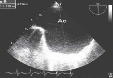Fig 49 Aneurisma de aorta descendente Abreviaturas Ao aorta Fig 410 - фото 48