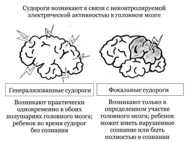 Генерализованные и фокальные судороги При фокальных судорогахнеконтролируемая - фото 7
