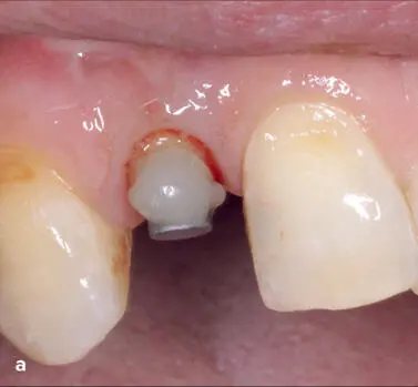 Fig 125 a to c After endodontic therapy and placemen - фото 101