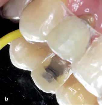 Fig 125 a to c After endodontic therapy and placement of a fiberreinforced - фото 102